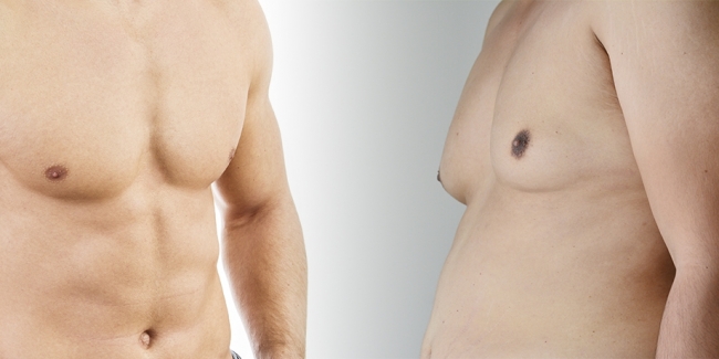 Ginecomastia en Valencia - Remodela tus pectorales