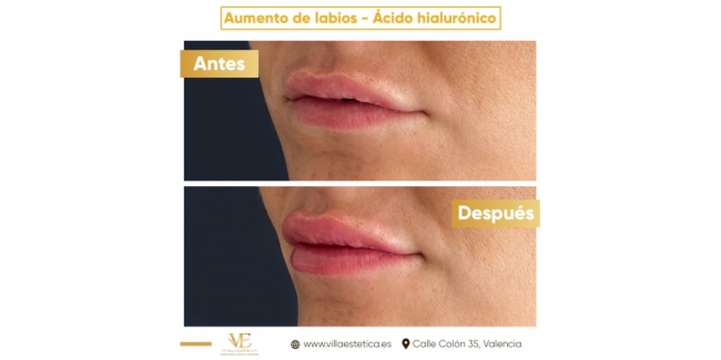 Sorteo aumento de labios en Valencia