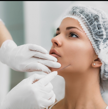 Hilos tensores espiculados