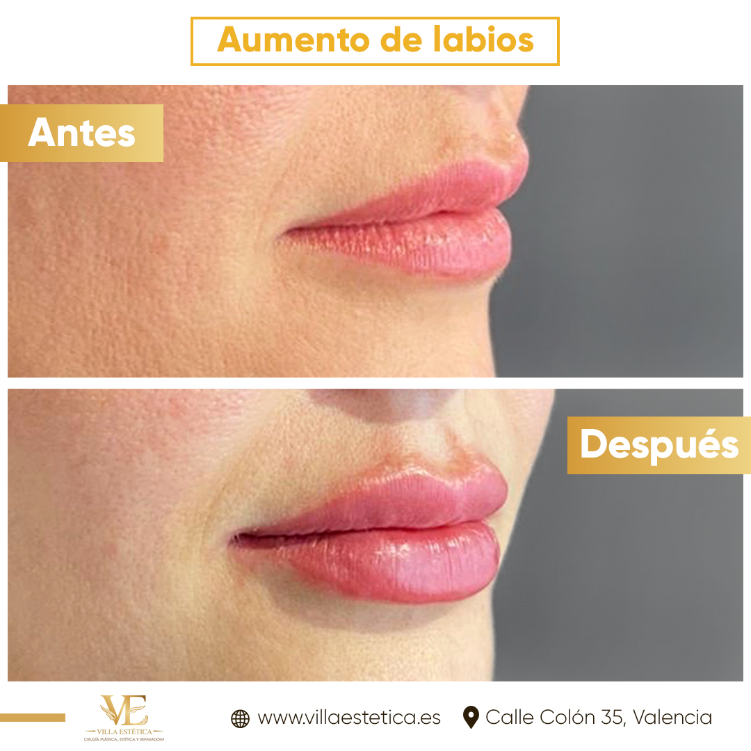 Aumento de Labios - Acidohialuronico